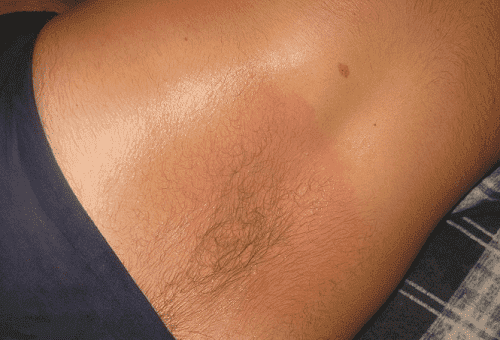 Como lavar Finalgon da pele, a fim de remover rapidamente uma sensação de queimação?